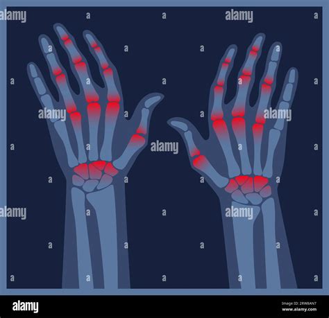 Arthritis Hands X Ray Pain In The Human Body Arthritis Bone Disease