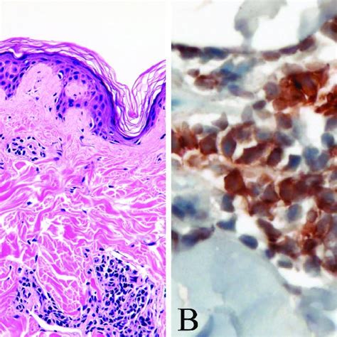 A Representative Photomicrograph Of A Skin Biopsy Specimen Displaying Download Scientific