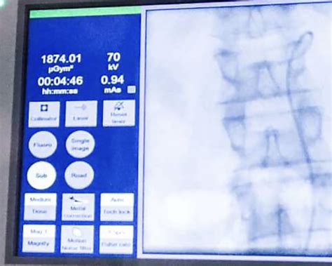 How Is Interventional Radiology Changing The Landscape Of Cancer