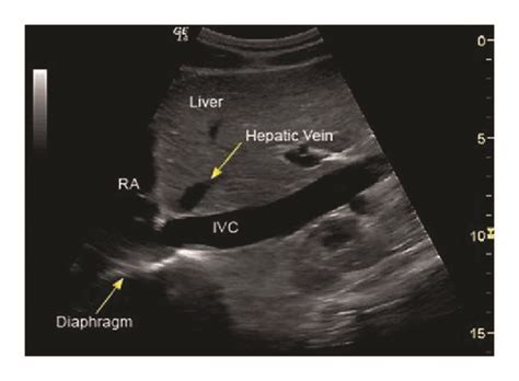 Subcostal Inferior Vena Cava Landmarks A Position Of Ultrasound