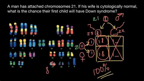 Nikolay's Genetics Lessons on LinkedIn: Unusual Down syndrome ...