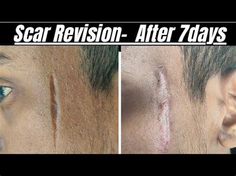 Scar Revision Surgery Result After Days Scar Revision Surgery In