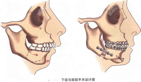 正颌手术到底是什么怎么做的请看正颌手术术式全解析 颌面对比照 8682整形网