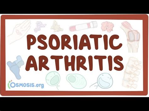 Psoriatic Arthritis - Causes, Symptoms, Diagnosis, Treatment, Pathology - 2024