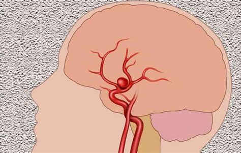 Brain Aneurysm Symptoms Causes Surgery And Treatment Left Side Pains