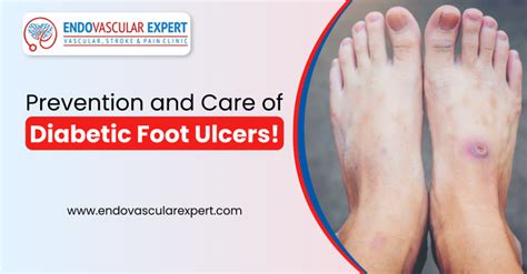 Prevention And Care Of Diabetic Foot Ulcers Endovascular