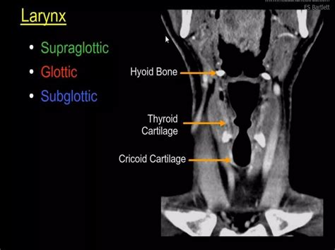 Ct Of The Larynx Ppt