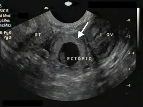 Ultrasound Diagnosis And Management Of Ectopic Pregnancy MyCME