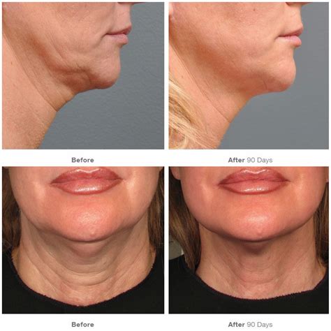 Ultherapy Before And After Artofit