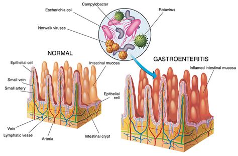 Gastroenteritis Healthdirect