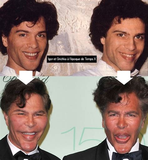 New Celebrity Buzz Bogdanoff Brothers Before After Plastic Surgery