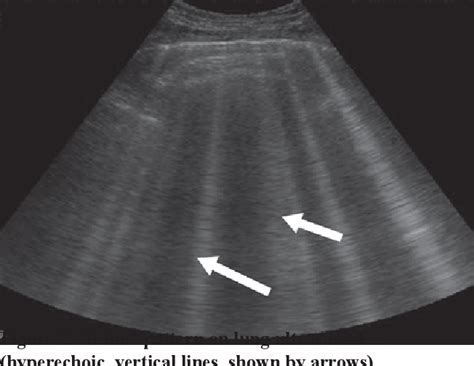 Figure 2 From Role Of Lung Ultrasound For Diagnosis Of Acute Respiratory Distress Syndrome In