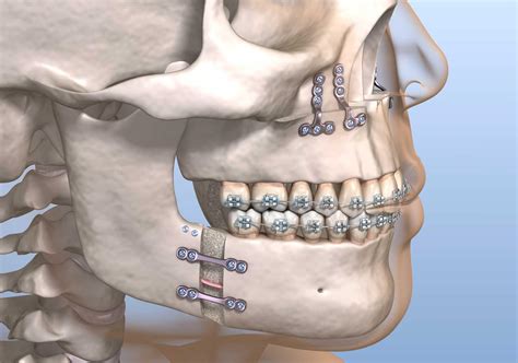 Você sabe como é o processo de recuperação da cirurgia ortognática