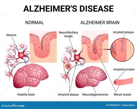 Alzheimer Disease And Changes In The Brain Stock Vector Illustration