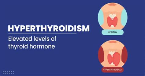 Hyperthroidism Meaning Symptoms Causes And Risk Factors Livofy