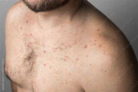 Naked Man With Red Pimples On His Chest Acne Skin Disease Dermatology Problem Stock Photo