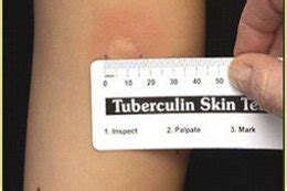 Reading the Test - Tuberculin Skin test (TST)