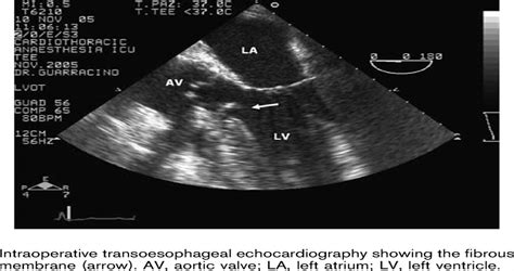 Discrete Subaortic Stenosis Associated With Calcific Aortic Journal Of Cardiovascular Medicine