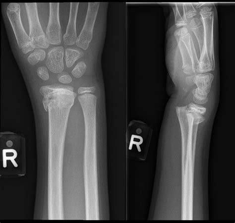 Anteroposterior And Lateral Radiographs Of The Left Wrist For Case