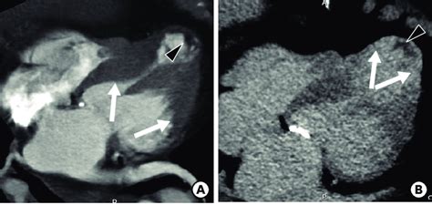 End Stage Midventricular Hypertrophic Cardiomyopathy In A 76 Year Old Download Scientific