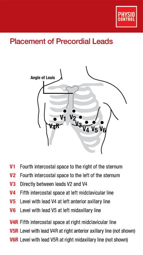 Precordial Leads Placement Card 3304235 - Placement of Precordial Leads ...