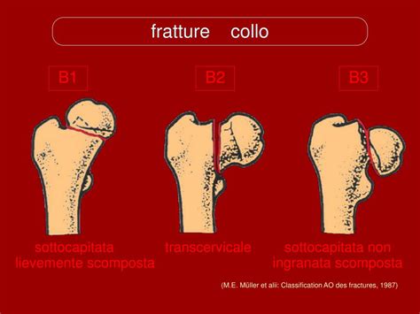 Ppt Fratture Prossimali Del Femore Powerpoint Presentation Free Download Id 4754380