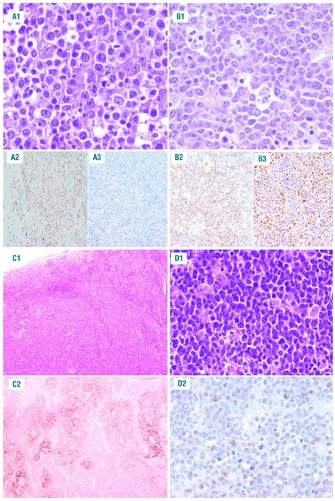 Burkitt Like Lymphoma With 11q Aberration A Germinal Center Derived