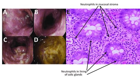 Figure Endoscopic Imagery Of The Distal Sigmoid Colon A Proximal Download Scientific