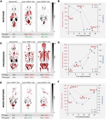 Frontiers Quantitative Imaging For Lu Psma Treatment Response