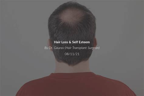 Hair Loss Self Esteem Cult Aesthetics