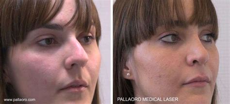 Rinoplastica Foto Chirurgia Estetica Pallaoro Medical Laser