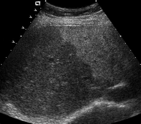Enlarged Liver Ultrasound