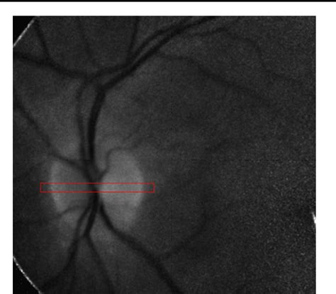 Figure 1 from Quantitative assessment of optic nerve head pallor ...