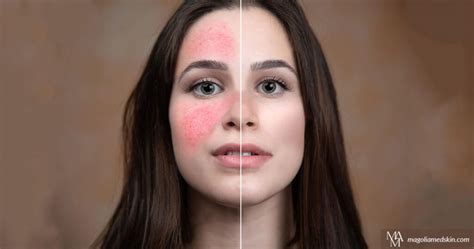 What Is The Best Treatment For Rosacea Magnolia Medical And Aesthetics