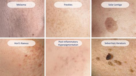 Types Of Hyperpigmentation Just About Skin