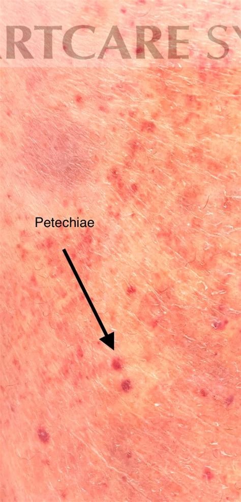 Amiodarone Induced Leukocytoclastic Vasculitis Lcv