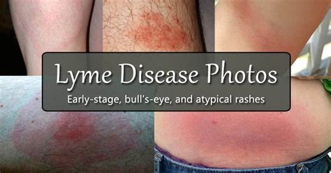 Lyme Disease Rash Symptoms Stages And Identification