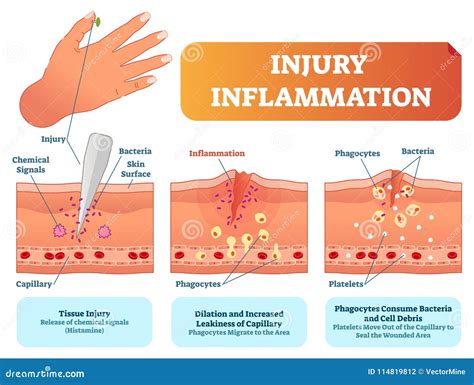 Wound Infection Diagram