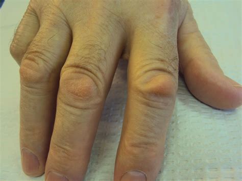 Dupuytren's: Knuckle Pads: Dorsal Dupuytren Nodules