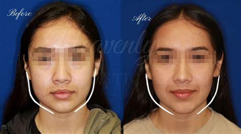 Buccal Fat Pad Removal Cheek Fat Removal Heavenly Plastic Surgery