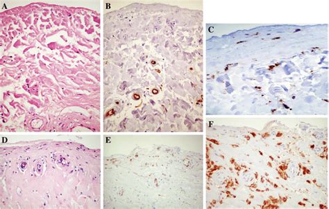 Parietal Peritoneal Biopsies Of Patient With Eps Ac And Control