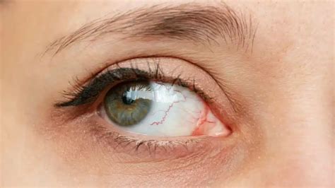 Keratitis Causes: Discovering What Leads to Corneal Inflammation