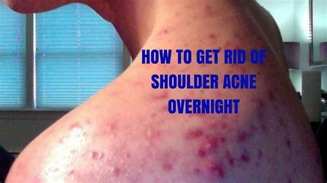 HOW TO GET RID OF SHOULDER ACNE OVERNIGHT YouTube