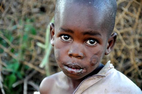 Starving Children In Africa