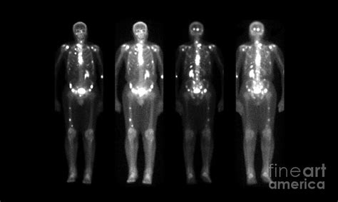 Nuclear Medicine Bone Scan By Medical Body Scans Nuclear Medicine