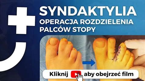 Syndaktylia Operacja Rozdzielenia Palc W U St P Szpital Dworska