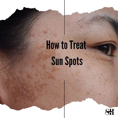 How To Treat Sunspots Skin Harmonics