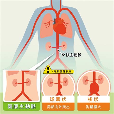 時常腰痠背痛 赫見腹主動脈瘤 自由健康網