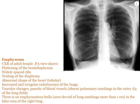 Emphysema Life Emphysema Stages Life Expectancy And Living With End