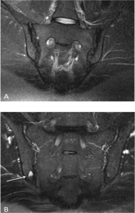 Sacroiliac Joint Dysfunction Mri